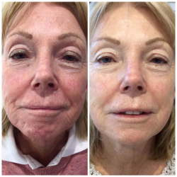 Before & after a course of A-lift Treatments KAM Beauty Salon, Lossiemouth