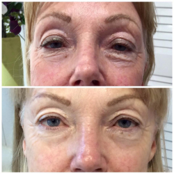 Before & after a course of A-lift Treatments KAM Beauty Salon, Lossiemouth