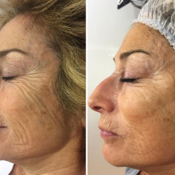 Before & after a course of A-lift Treatments KAM Beauty Salon, Lossiemouth